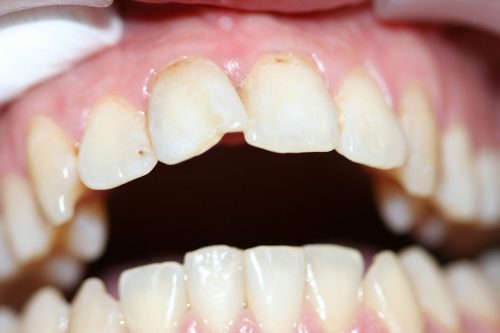 Зубной камень: что это и как избавиться?
