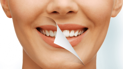 Особенности и преимущества ультразвукового отбеливания зубов