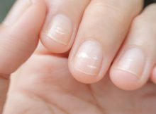 Почему на ногтях появляются поперечные полосы и белые пятна