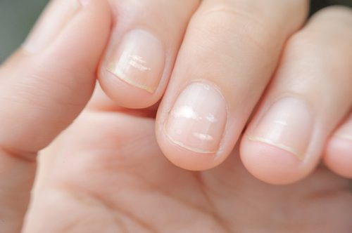 Почему на ногтях появляются поперечные полосы и белые пятна