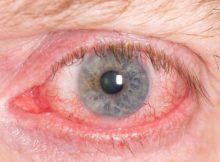 Глаукома, ее симптомы и лечение