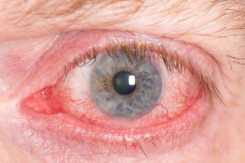 Глаукома, ее симптомы и лечение