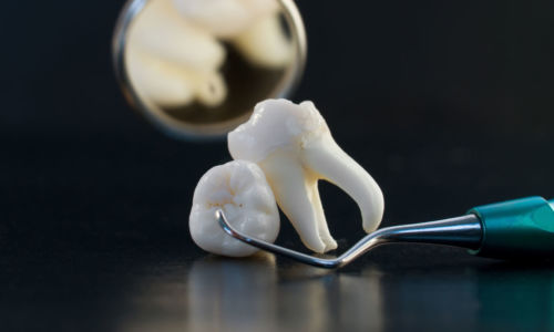 Удаление зубов в стоматологии: стоит ли бояться?