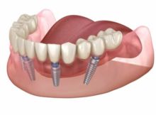 Преимущества имплантации зубов по методике all on 4