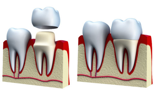 Современная стоматология. Какие бывают коронки на зубы