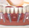 Что делать, если все зубы утрачены? Рассказывает стоматолог Капил Кхурана