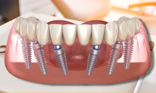 Что делать, если все зубы утрачены? Рассказывает стоматолог Капил Кхурана